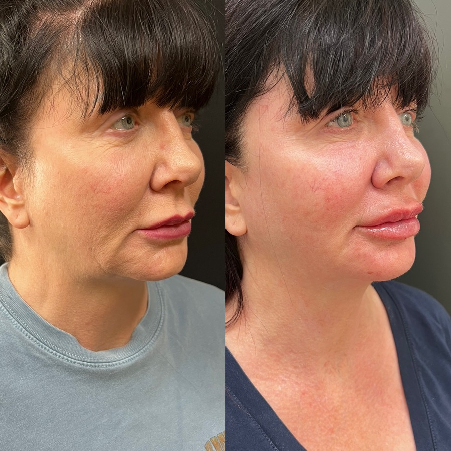 Composite before-and-after photographs showing facial balancing and lower-face, jawline, and neck rejuvenation following a combination treatment plan.