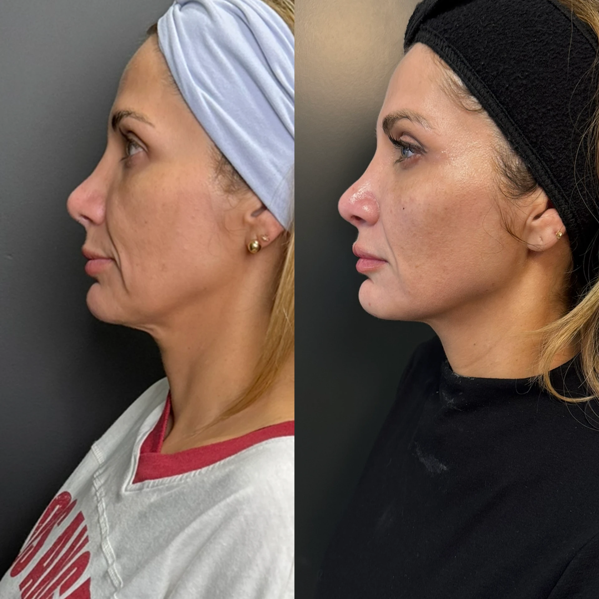 Composite before-and-after profile view showing facial and lower-face refinement at an eight-month follow-up after a combination treatment plan with Matrix Pro, Sculptra, neurotoxin, and dermal filler.
