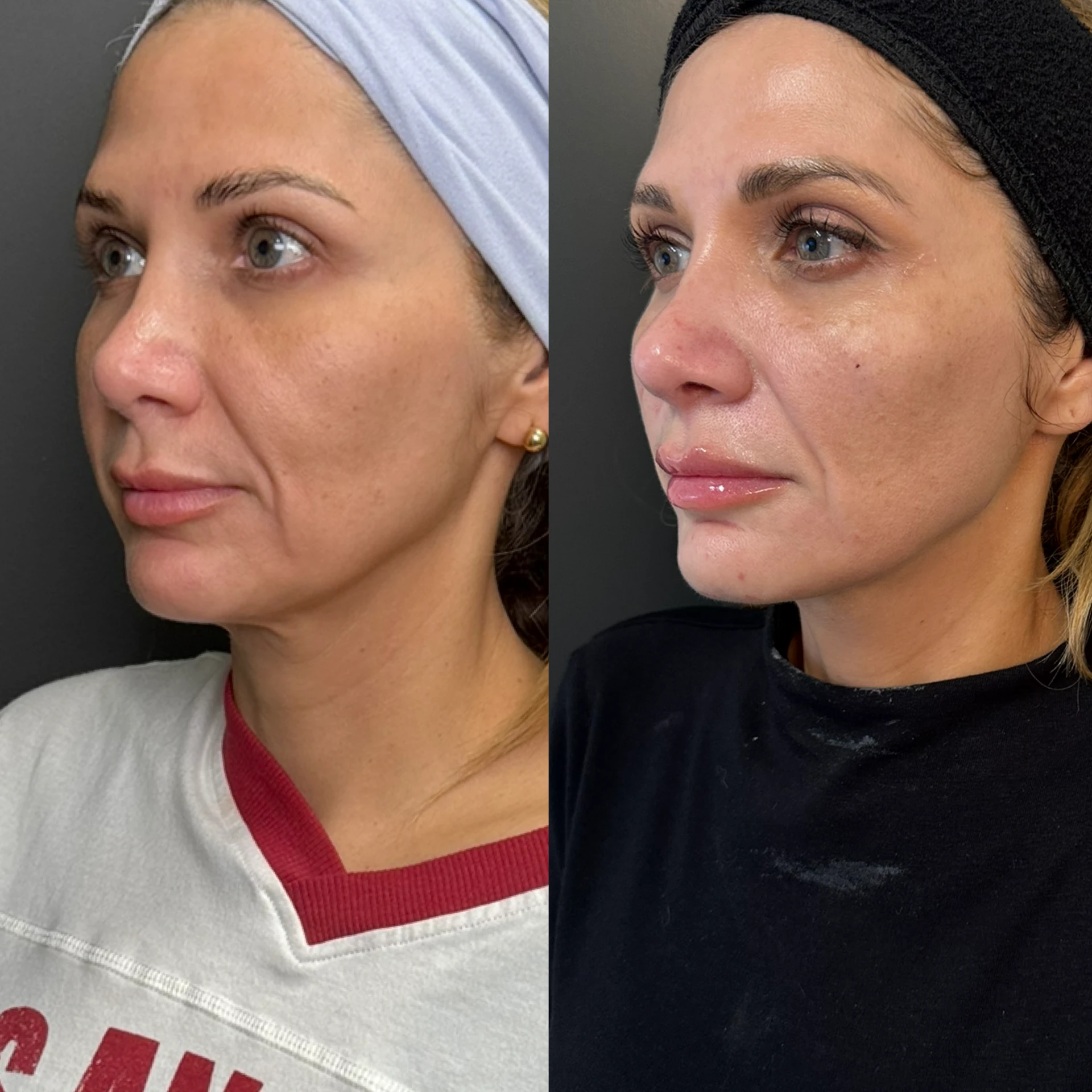 Composite before-and-after three-quarter view showing facial rejuvenation and balancing at an eight-month follow-up after a combination treatment plan with Matrix Pro, Sculptra, neurotoxin, and dermal filler.
