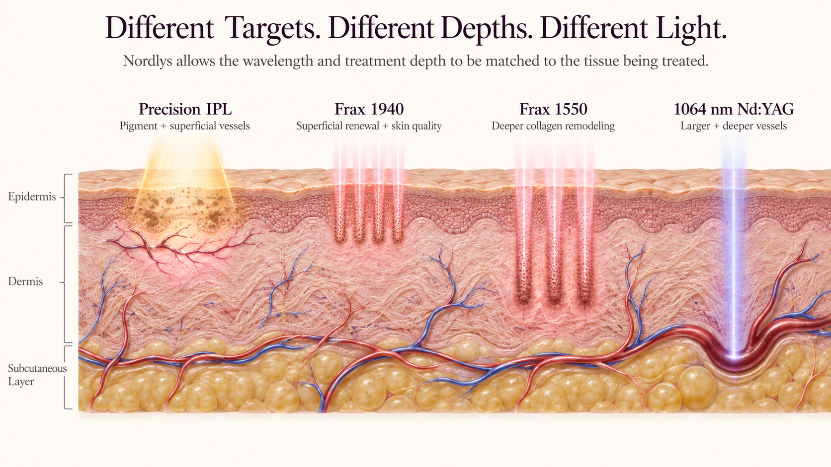 Diagram showing how Nordlys Precision IPL, Frax 1940, Frax 1550, and 1064 nm Nd:YAG address different skin targets and treatment depths.