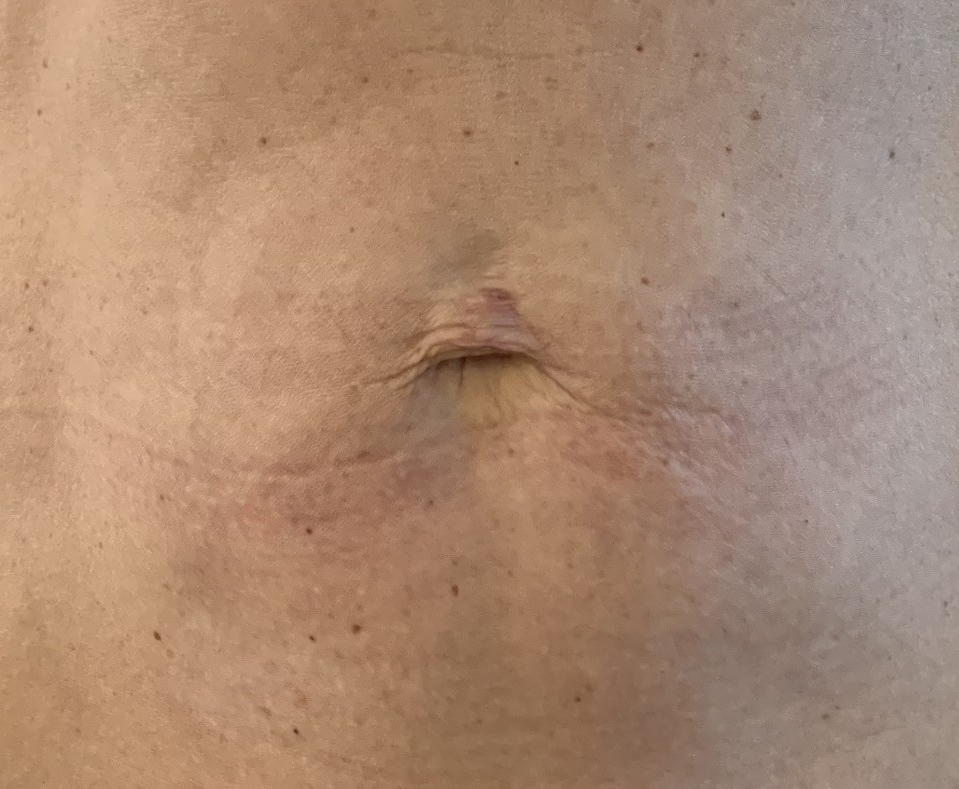 After abdominal skin tightening with Profound performed by Dr. Scott Gerrish, DO.