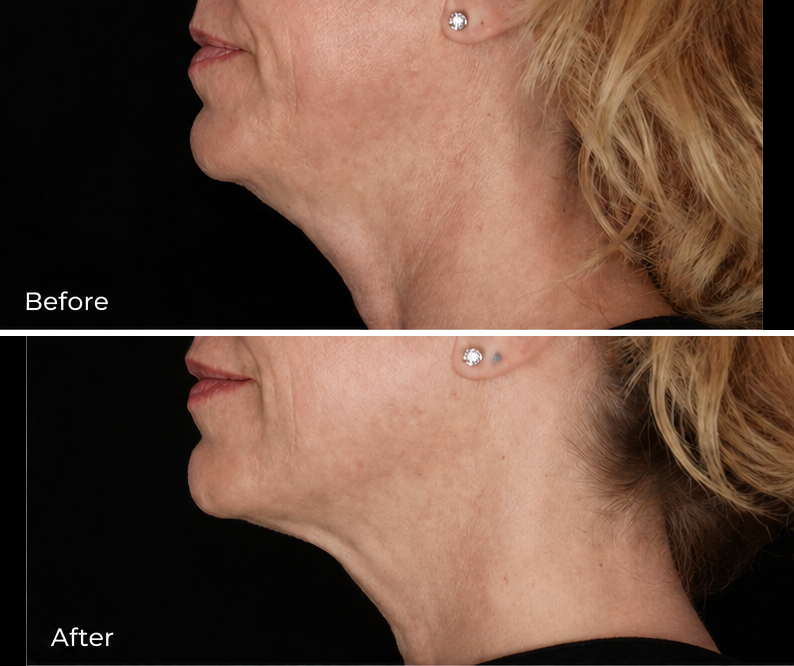 Silent Lift™ before and after: neck and jawline profile, before photo above and after photo below