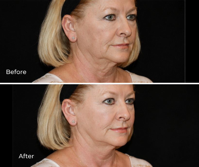 Silent Lift™ before and after: three-quarter facial view, before photo above and after photo below