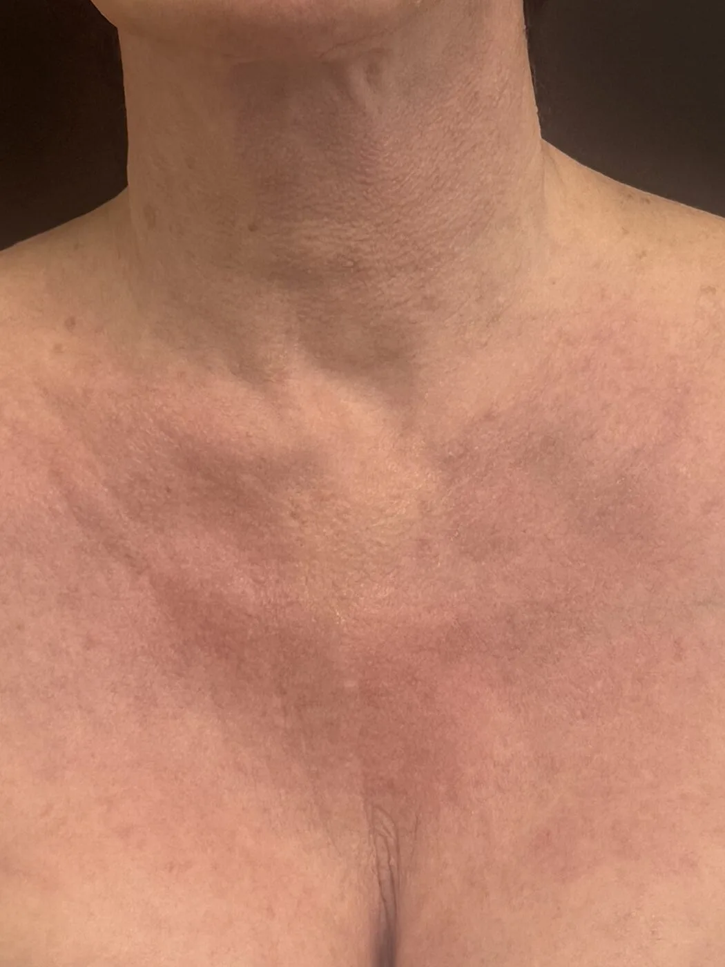 After neck and décolleté resurfacing
