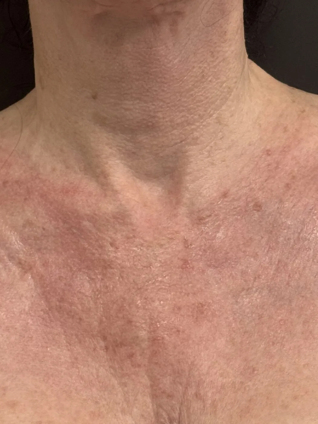 Before neck and décolleté resurfacing
